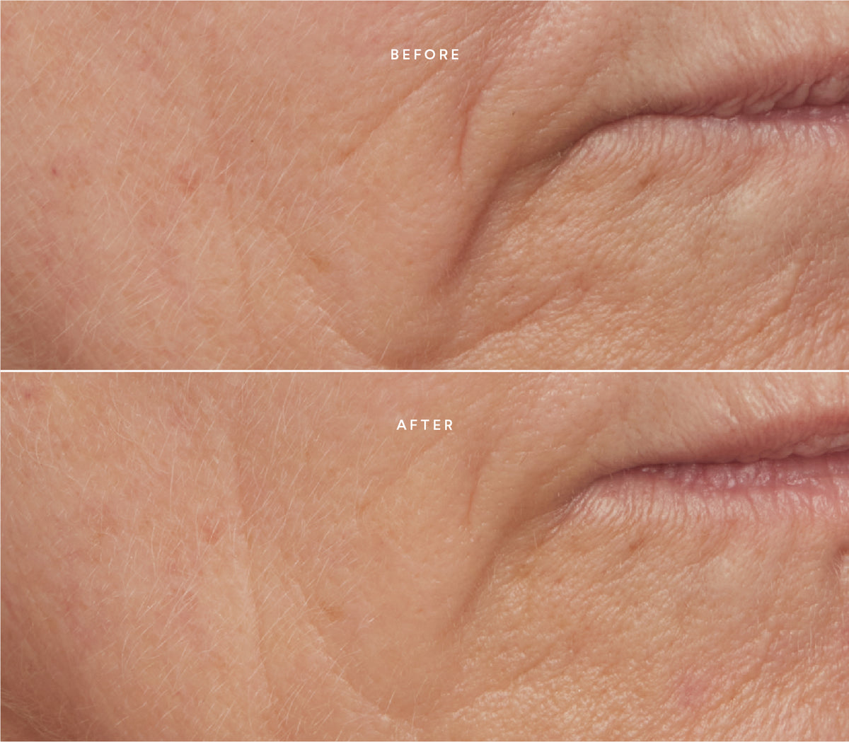 Before and after comparison showing smoother skin texture and reduced fine lines around the mouth area.