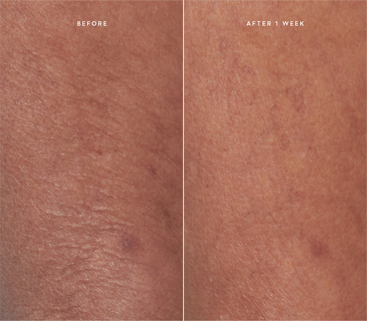 Before and after comparison showing improved skin texture.