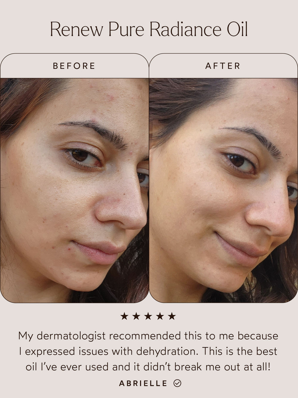 A before-and-after comparison image showcasing the results of Renew Pure Radiance Oil. The "Before" image reveals signs of dehydration, blemishes, and uneven skin texture, while the "After" image highlights smoother, hydrated, and more radiant skin. Below, a testimonial from Abrielle reads:
"My dermatologist recommended this to me because I expressed issues with dehydration. This is the best oil I’ve ever used and it didn’t break me out at all!"