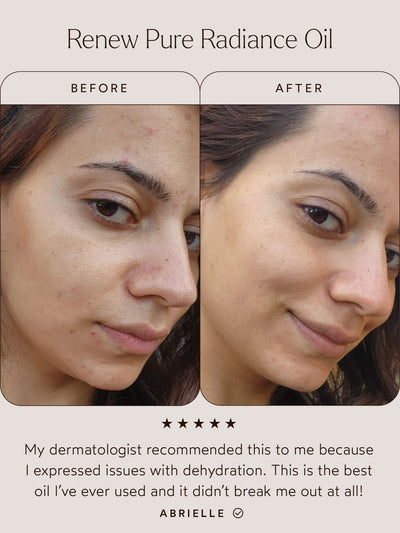 A before-and-after comparison image showcasing the results of Renew Pure Radiance Oil. The "Before" image reveals signs of dehydration, blemishes, and uneven skin texture, while the "After" image highlights smoother, hydrated, and more radiant skin. Below, a testimonial from Abrielle reads:
"My dermatologist recommended this to me because I expressed issues with dehydration. This is the best oil I’ve ever used and it didn’t break me out at all!"